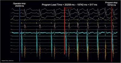 Automatic algorithmic driven monitoring of atrioventricular nodal re-entrant tachycardia ablation to improve procedural safety